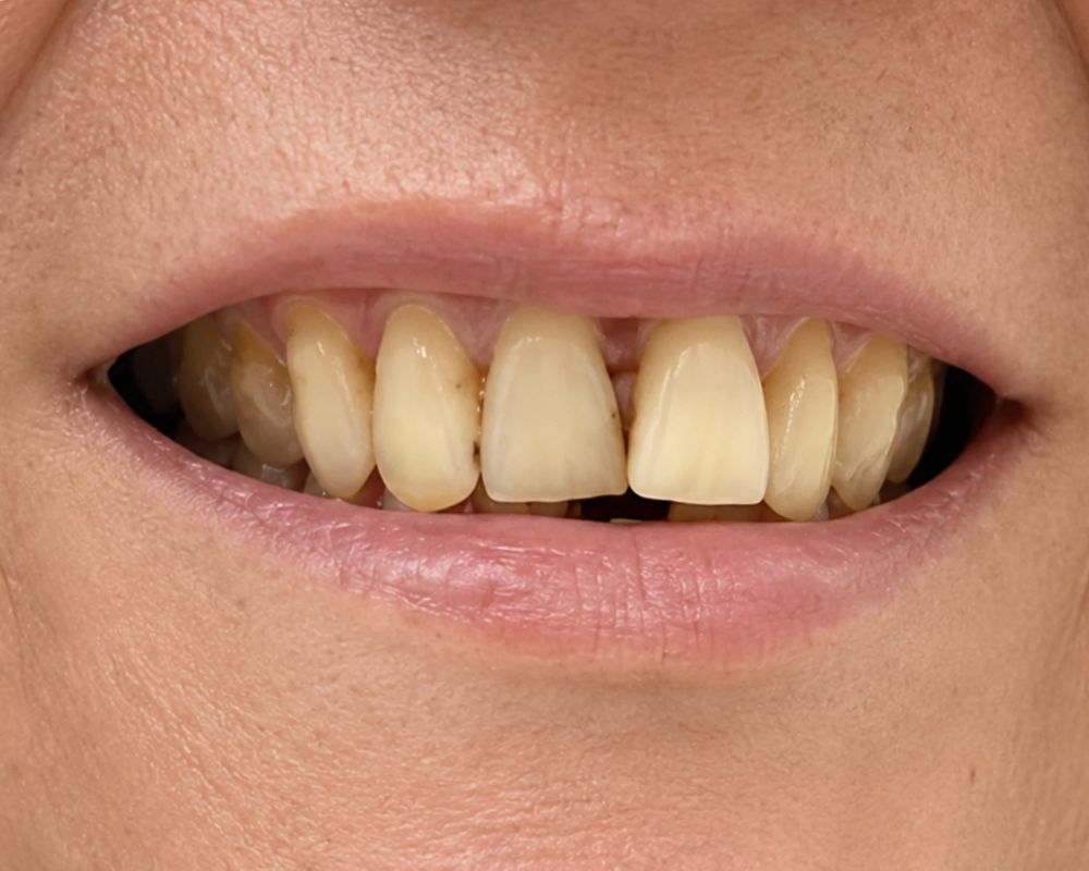 Antes da reabilitação com implantes