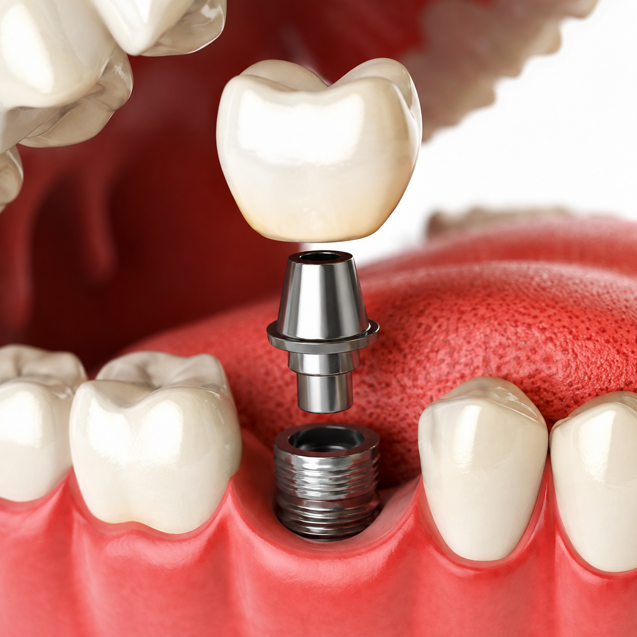 Implantes dentários e prótese fixa